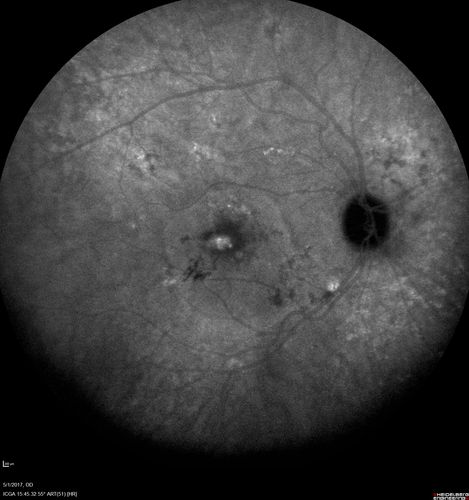 Central Serous Retinopathy - Subretinal Fibrin
66 year old female with 20 year history of single episode of CSR.  Now with vision loss for a month but improving - VA 20/63 OD; 20/32 OS
