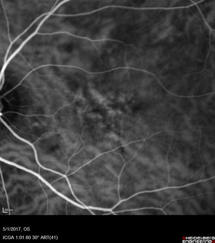 Central Serous Retinopathy - Subretinal Fibrin
66 year old female with 20 year history of single episode of CSR.  Now with vision loss for a month but improving - VA 20/63 OD; 20/32 OS
