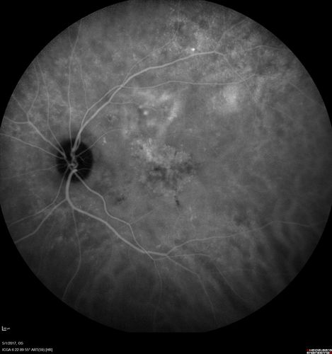 Central Serous Retinopathy - Subretinal Fibrin
66 year old female with 20 year history of single episode of CSR.  Now with vision loss for a month but improving - VA 20/63 OD; 20/32 OS
