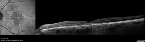 Central Serous Retinopathy - Subretinal Fibrin
66 year old female with 20 year history of single episode of CSR.  Now with vision loss for a month but improving - VA 20/63 OD; 20/32 OS
