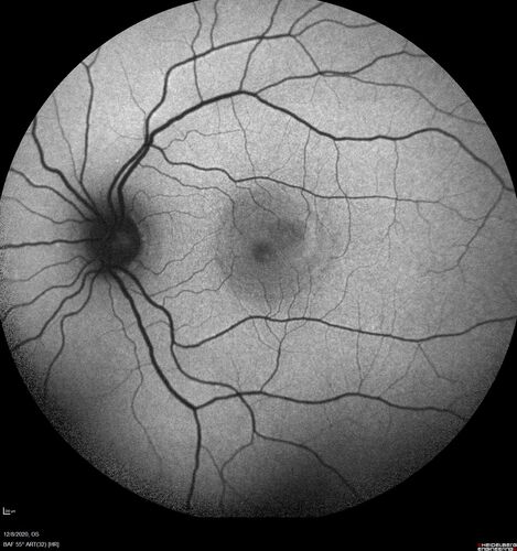 Central Serous Chorioretinopathy - Expanding hot spot - photodynamic laser
35 year old man with acute central serous chorioretinopathy.  The fluid got better then worse and the patient was treated with full strength juxtafoveal PDT and then got better.
