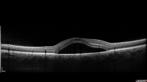 Central Serous Chorioretinopathy - Expanding hot spot - photodynamic laser
35 year old man with acute central serous chorioretinopathy.  The fluid got better then worse and the patient was treated with full strength juxtafoveal PDT and then got better.
