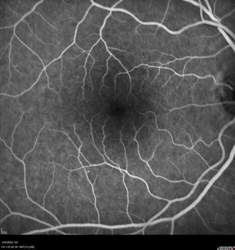 Central Serous Chorioretinopathy - Expanding hot spot - photodynamic laser
35 year old man with acute central serous chorioretinopathy.  The fluid got better then worse and the patient was treated with full strength juxtafoveal PDT and then got better.
