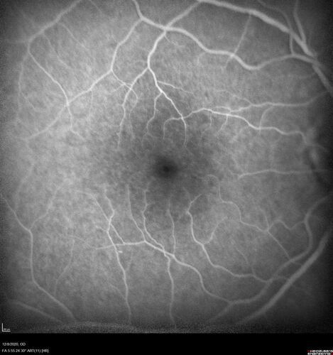 Central Serous Chorioretinopathy - Expanding hot spot - photodynamic laser
35 year old man with acute central serous chorioretinopathy.  The fluid got better then worse and the patient was treated with full strength juxtafoveal PDT and then got better.
