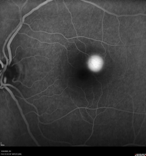 Central Serous Chorioretinopathy - Expanding hot spot - photodynamic laser
35 year old man with acute central serous chorioretinopathy.  The fluid got better then worse and the patient was treated with full strength juxtafoveal PDT and then got better.
