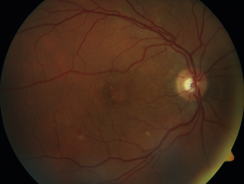 Chronic CSR with mild vision loss - Macular Atrophy Right Eye
55 year old man has not been to an eye doctor in years.  VA 20/40 OD and 20/25 OS.  OCT shows outer retinal atrophy and choroidal thickening.  FAF shows guttering.  FA shows no active lesions.  ICG shows patchy mild leakage visible at about 5 minutes.
