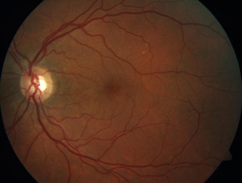 Chronic CSR with mild vision loss - Macular Atrophy Right Eye
55 year old man has not been to an eye doctor in years.  VA 20/40 OD and 20/25 OS.  OCT shows outer retinal atrophy and choroidal thickening.  FAF shows guttering.  FA shows no active lesions.  ICG shows patchy mild leakage visible at about 5 minutes.
