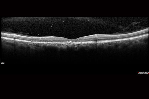 Chronic CSR with mild vision loss - Macular Atrophy Right Eye
55 year old man has not been to an eye doctor in years.  VA 20/40 OD and 20/25 OS.  OCT shows outer retinal atrophy and choroidal thickening.  FAF shows guttering.  FA shows no active lesions.  ICG shows patchy mild leakage visible at about 5 minutes.
