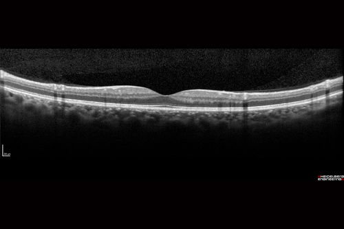 Chronic CSR with mild vision loss - Macular Atrophy Right Eye
55 year old man has not been to an eye doctor in years.  VA 20/40 OD and 20/25 OS.  OCT shows outer retinal atrophy and choroidal thickening.  FAF shows guttering.  FA shows no active lesions.  ICG shows patchy mild leakage visible at about 5 minutes.
