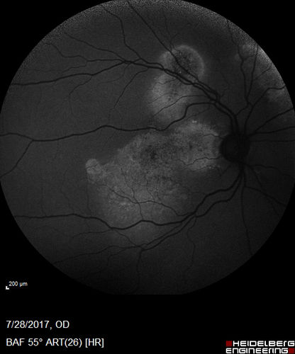 Chronic CSR with mild vision loss - Macular Atrophy Right Eye
55 year old man has not been to an eye doctor in years.  VA 20/40 OD and 20/25 OS.  OCT shows outer retinal atrophy and choroidal thickening.  FAF shows guttering.  FA shows no active lesions.  ICG shows patchy mild leakage visible at about 5 minutes.
