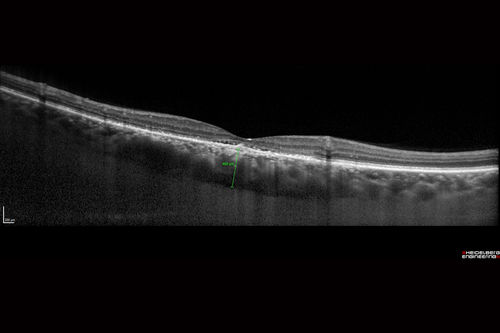 Chronic CSR with mild vision loss - Macular Atrophy Right Eye
55 year old man has not been to an eye doctor in years.  VA 20/40 OD and 20/25 OS.  OCT shows outer retinal atrophy and choroidal thickening.  FAF shows guttering.  FA shows no active lesions.  ICG shows patchy mild leakage visible at about 5 minutes.
