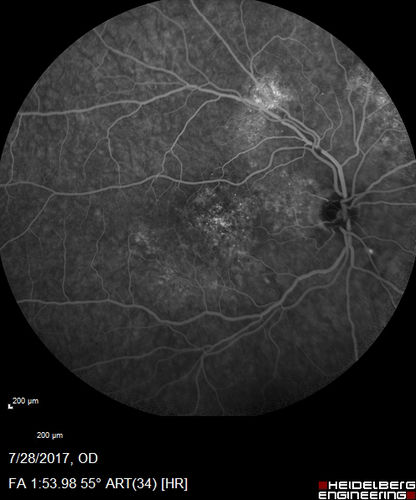 Chronic CSR with mild vision loss - Macular Atrophy Right Eye
55 year old man has not been to an eye doctor in years.  VA 20/40 OD and 20/25 OS.  OCT shows outer retinal atrophy and choroidal thickening.  FAF shows guttering.  FA shows no active lesions.  ICG shows patchy mild leakage visible at about 5 minutes.
