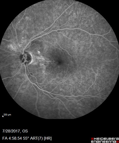 Chronic CSR with mild vision loss - Macular Atrophy Right Eye
55 year old man has not been to an eye doctor in years.  VA 20/40 OD and 20/25 OS.  OCT shows outer retinal atrophy and choroidal thickening.  FAF shows guttering.  FA shows no active lesions.  ICG shows patchy mild leakage visible at about 5 minutes.
