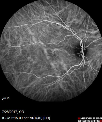 Chronic CSR with mild vision loss - Macular Atrophy Right Eye
55 year old man has not been to an eye doctor in years.  VA 20/40 OD and 20/25 OS.  OCT shows outer retinal atrophy and choroidal thickening.  FAF shows guttering.  FA shows no active lesions.  ICG shows patchy mild leakage visible at about 5 minutes.
