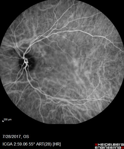 Chronic CSR with mild vision loss - Macular Atrophy Right Eye
55 year old man has not been to an eye doctor in years.  VA 20/40 OD and 20/25 OS.  OCT shows outer retinal atrophy and choroidal thickening.  FAF shows guttering.  FA shows no active lesions.  ICG shows patchy mild leakage visible at about 5 minutes.
