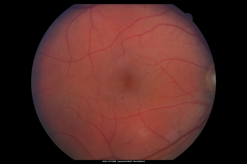 Idiopathic Central Serous Retinopathy - Bilateral - Acute 
49-year-old man  decreasing vision in the left eye for one week.  He is not taking any steroid or steroid-related products.  His blood pressure as far as he knows is under control.

VISUAL ACUITY:  OD 20/30, OS 20/400
