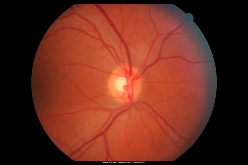 Idiopathic Central Serous Retinopathy - Bilateral - Acute 
49-year-old man  decreasing vision in the left eye for one week.  He is not taking any steroid or steroid-related products.  His blood pressure as far as he knows is under control.

VISUAL ACUITY:  OD 20/30, OS 20/400
