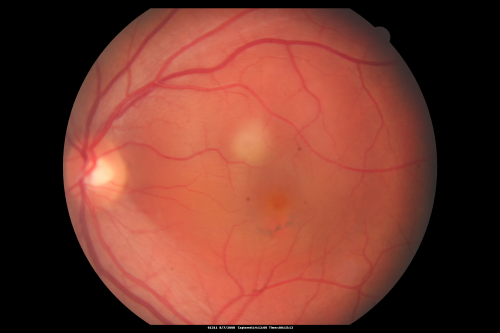 Idiopathic Central Serous Retinopathy - Bilateral - Acute 
49-year-old man  decreasing vision in the left eye for one week.  He is not taking any steroid or steroid-related products.  His blood pressure as far as he knows is under control.

VISUAL ACUITY:  OD 20/30, OS 20/400
