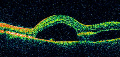 Idiopathic Central Serous Retinopathy - Bilateral - Acute 
49-year-old man  decreasing vision in the left eye for one week.  He is not taking any steroid or steroid-related products.  His blood pressure as far as he knows is under control.

VISUAL ACUITY:  OD 20/30, OS 20/400
