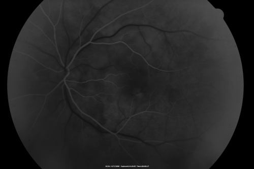 Idiopathic Central Serous Retinopathy - Bilateral - Acute 
49-year-old man  decreasing vision in the left eye for one week.  He is not taking any steroid or steroid-related products.  His blood pressure as far as he knows is under control.

VISUAL ACUITY:  OD 20/30, OS 20/400
