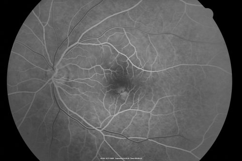Idiopathic Central Serous Retinopathy - Bilateral - Acute 
49-year-old man  decreasing vision in the left eye for one week.  He is not taking any steroid or steroid-related products.  His blood pressure as far as he knows is under control.

VISUAL ACUITY:  OD 20/30, OS 20/400
