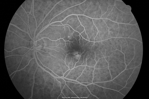 Idiopathic Central Serous Retinopathy - Bilateral - Acute 
49-year-old man  decreasing vision in the left eye for one week.  He is not taking any steroid or steroid-related products.  His blood pressure as far as he knows is under control.

VISUAL ACUITY:  OD 20/30, OS 20/400
