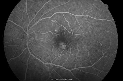 Idiopathic Central Serous Retinopathy - Bilateral - Acute 
49-year-old man  decreasing vision in the left eye for one week.  He is not taking any steroid or steroid-related products.  His blood pressure as far as he knows is under control.

VISUAL ACUITY:  OD 20/30, OS 20/400
