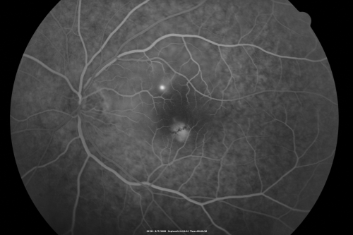 Idiopathic Central Serous Retinopathy - Bilateral - Acute 
49-year-old man  decreasing vision in the left eye for one week.  He is not taking any steroid or steroid-related products.  His blood pressure as far as he knows is under control.

VISUAL ACUITY:  OD 20/30, OS 20/400
