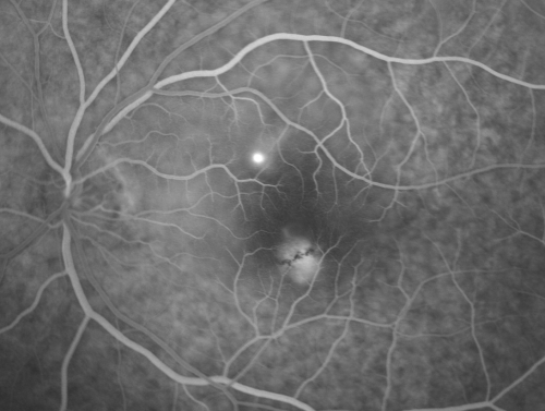 Idiopathic Central Serous Retinopathy - Bilateral - Acute 
49-year-old man  decreasing vision in the left eye for one week.  He is not taking any steroid or steroid-related products.  His blood pressure as far as he knows is under control.

VISUAL ACUITY:  OD 20/30, OS 20/400
