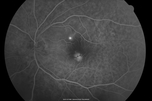 Idiopathic Central Serous Retinopathy - Bilateral - Acute 
49-year-old man  decreasing vision in the left eye for one week.  He is not taking any steroid or steroid-related products.  His blood pressure as far as he knows is under control.

VISUAL ACUITY:  OD 20/30, OS 20/400
