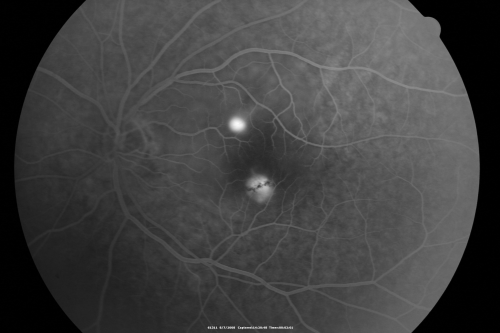 Idiopathic Central Serous Retinopathy - Bilateral - Acute 
49-year-old man  decreasing vision in the left eye for one week.  He is not taking any steroid or steroid-related products.  His blood pressure as far as he knows is under control.

VISUAL ACUITY:  OD 20/30, OS 20/400
