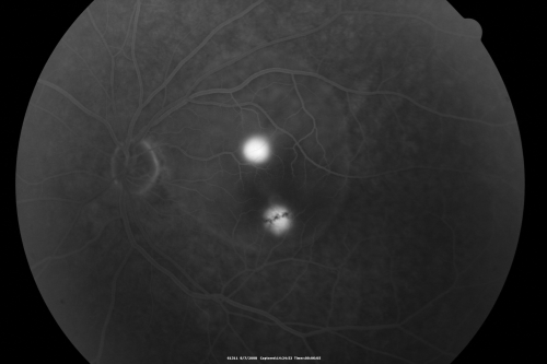 Idiopathic Central Serous Retinopathy - Bilateral - Acute 
49-year-old man  decreasing vision in the left eye for one week.  He is not taking any steroid or steroid-related products.  His blood pressure as far as he knows is under control.

VISUAL ACUITY:  OD 20/30, OS 20/400
