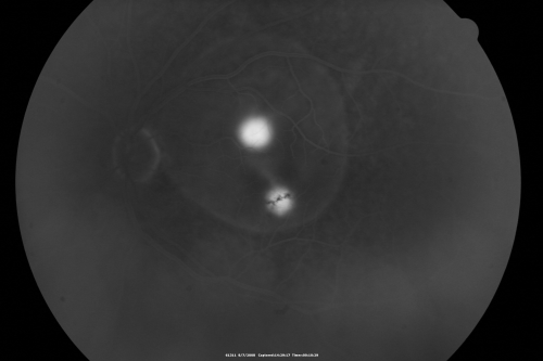 Idiopathic Central Serous Retinopathy - Bilateral - Acute 
49-year-old man  decreasing vision in the left eye for one week.  He is not taking any steroid or steroid-related products.  His blood pressure as far as he knows is under control.

VISUAL ACUITY:  OD 20/30, OS 20/400
