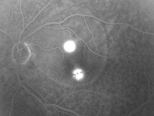 Idiopathic Central Serous Retinopathy - Bilateral - Acute 
49-year-old man  decreasing vision in the left eye for one week.  He is not taking any steroid or steroid-related products.  His blood pressure as far as he knows is under control.

VISUAL ACUITY:  OD 20/30, OS 20/400
