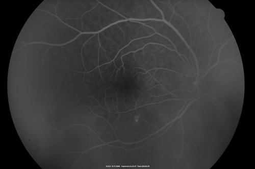 Idiopathic Central Serous Retinopathy - Bilateral - Acute 
49-year-old man  decreasing vision in the left eye for one week.  He is not taking any steroid or steroid-related products.  His blood pressure as far as he knows is under control.

VISUAL ACUITY:  OD 20/30, OS 20/400
