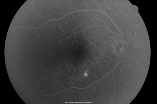 Idiopathic Central Serous Retinopathy - Bilateral - Acute 
49-year-old man  decreasing vision in the left eye for one week.  He is not taking any steroid or steroid-related products.  His blood pressure as far as he knows is under control.

VISUAL ACUITY:  OD 20/30, OS 20/400
