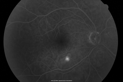 Idiopathic Central Serous Retinopathy - Bilateral - Acute 
49-year-old man  decreasing vision in the left eye for one week.  He is not taking any steroid or steroid-related products.  His blood pressure as far as he knows is under control.

VISUAL ACUITY:  OD 20/30, OS 20/400
