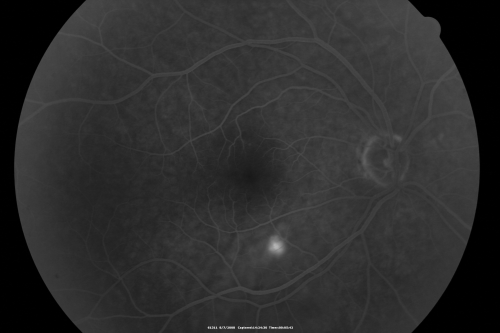 Idiopathic Central Serous Retinopathy - Bilateral - Acute 
49-year-old man  decreasing vision in the left eye for one week.  He is not taking any steroid or steroid-related products.  His blood pressure as far as he knows is under control.

VISUAL ACUITY:  OD 20/30, OS 20/400
