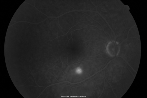 Idiopathic Central Serous Retinopathy - Bilateral - Acute 
49-year-old man  decreasing vision in the left eye for one week.  He is not taking any steroid or steroid-related products.  His blood pressure as far as he knows is under control.

VISUAL ACUITY:  OD 20/30, OS 20/400
