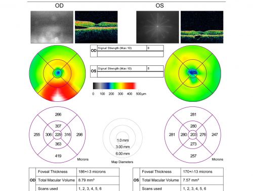Idiopathic Central Serous Retinopathy - Bilateral - Acute 4 months later VA 20/40 OU
No treatment and fluid under fovea in left eye is competely absorbed at 4 months.
