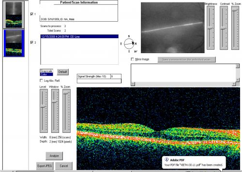 Idiopathic Central Serous Retinopathy - Bilateral - Acute 4 months later VA 20/40 OU
No treatment and fluid under fovea in left eye is competely absorbed at 4 months.
