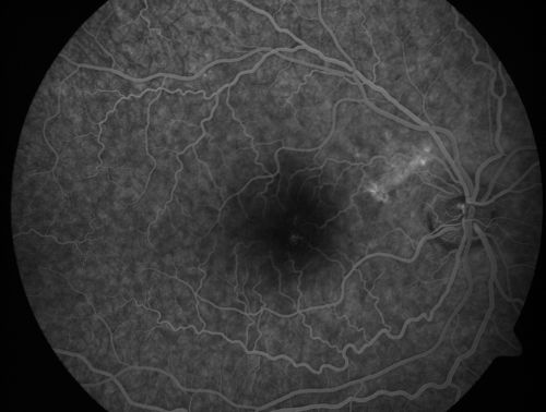 Chronic Central Serous Retinopathy treated with Photodynamic Laser and Visudyne
48-year-old man has had waxing and waning vision in the left eye for the last year from central serous retinopathy. OD is 20/16, OS is 20/30.
