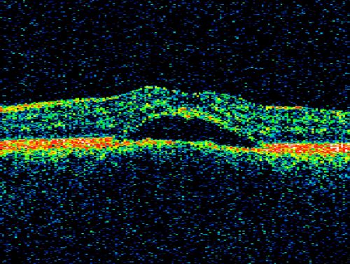 Chronic Central Serous Retinopathy treated with Photodynamic Laser and Visudyne
48-year-old man has had waxing and waning vision in the left eye for the last year from central serous retinopathy. OD is 20/16, OS is 20/30.
