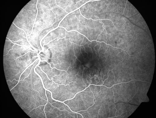 Chronic Central Serous Retinopathy treated with Photodynamic Laser and Visudyne
48-year-old man has had waxing and waning vision in the left eye for the last year from central serous retinopathy. OD is 20/16, OS is 20/30.

