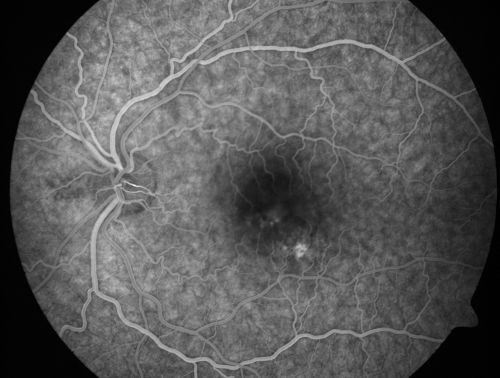 Chronic Central Serous Retinopathy treated with Photodynamic Laser and Visudyne
48-year-old man has had waxing and waning vision in the left eye for the last year from central serous retinopathy. OD is 20/16, OS is 20/30.
