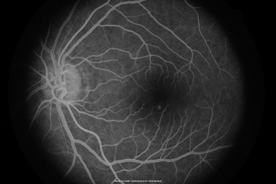 Central Serous Retinopathy
Early FA
Keywords: Central Serous Retinopathy