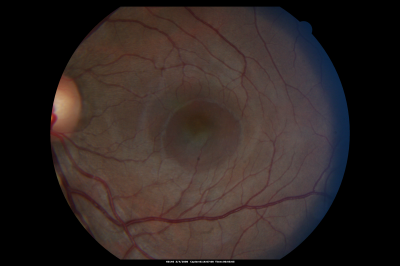 Central Serous Retinopathy
Fundus photo showing serous RD
Võtmesõnad: Central Serous Retinopathy