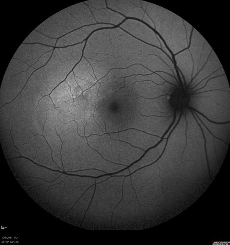 Acute Central Serous Retinopathy - CSR - Steroid Induced (probably) - Good Vision - Fundus HyperAutofluorescence Serous Retinal Detachment
42-year-old man was seen in the office on October 5, 2011.  He had noticed starting in August after a course of antibiotic and steroids, that he developed new spots in his vision in the right eye.  He may have had an episode like this sometime in the past.  He did take steroids a few years ago and his vision did change at that time, but then returned.  

VISUAL ACUITY:  OD 20/32,  OS 20/32.  The OCT scan of the right eye confirms subretinal fluid.
