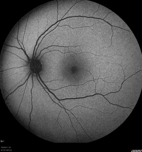 Acute Central Serous Retinopathy - CSR - Steroid Induced (probably) - Good Vision - Fundus Autofluorescence
42-year-old man was seen in the office on October 5, 2011.  He had noticed starting in August after a course of antibiotic and steroids, that he developed new spots in his vision in the right eye.  He may have had an episode like this sometime in the past.  He did take steroids a few years ago and his vision did change at that time, but then returned.  

VISUAL ACUITY:  OD 20/32,  OS 20/32.  The OCT scan of the right eye confirms subretinal fluid.
