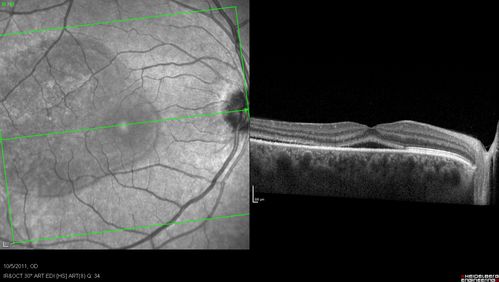 Acute Central Serous Retinopathy - CSR - Steroid Induced (probably) - Good Vision 
42-year-old man was seen in the office on October 5, 2011.  He had noticed starting in August after a course of antibiotic and steroids, that he developed new spots in his vision in the right eye.  He may have had an episode like this sometime in the past.  He did take steroids a few years ago and his vision did change at that time, but then returned.  

VISUAL ACUITY:  OD 20/32,  OS 20/32.  The OCT scan of the right eye confirms subretinal fluid.
